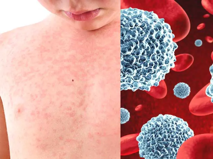 ما علامات سرطان الدم