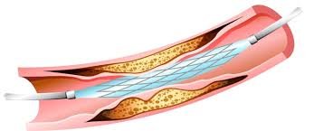 شكل قسطرة القلب