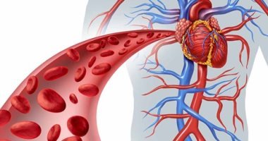 مرض تمدد الاوعية الدموية