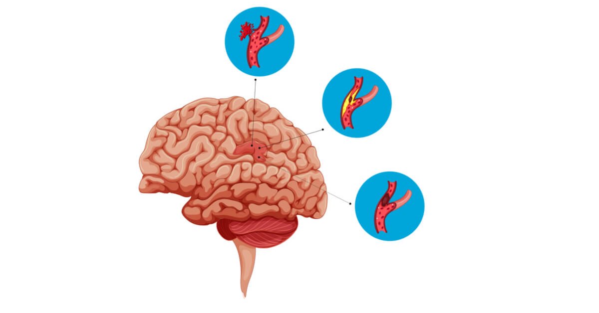 علاج تمدد الأوعية الدموية في الدماغ