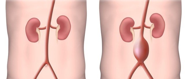 تمدد الاوعية الدموية في البطن