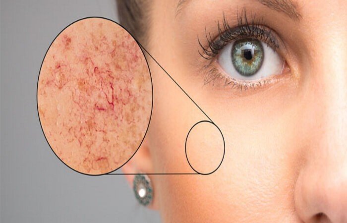 تمدد الاوعية الدموية في الوجه