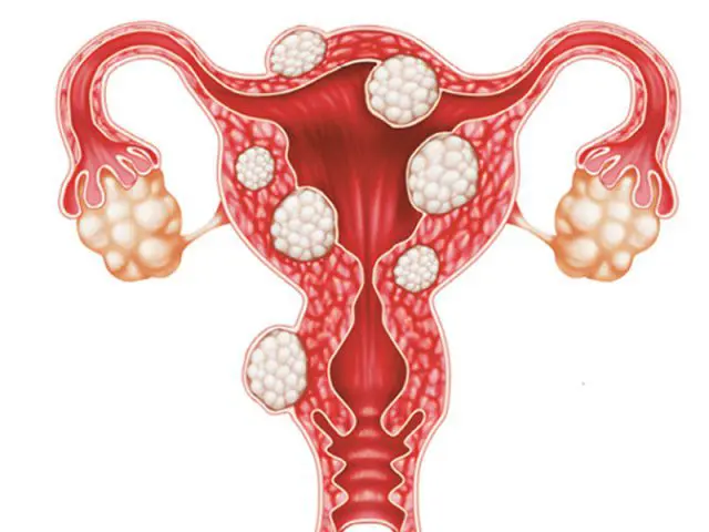 الاورام الليفية