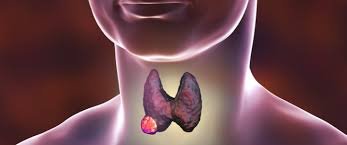 علاج أورام الغدة الدرقية بالاشعة التداخلية 