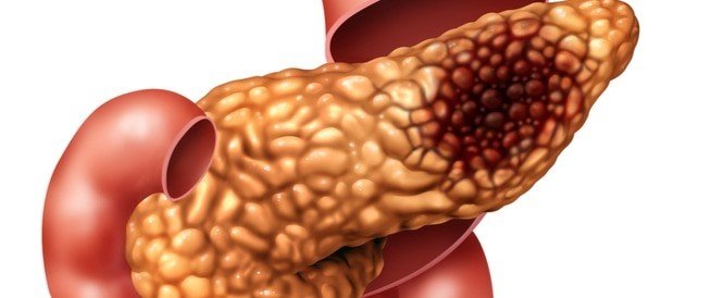 علاج اورام البنكرياس